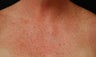 Intense Pulsed Light