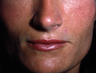 Facial Volumizing with Fillers
