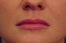 Injectable Filler