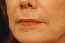 Restylane injectable filler