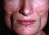 Facial Volumizing with Fillers