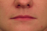 Injectable Filler