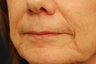 Restylane injectable filler