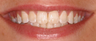 Invisalign and whitening