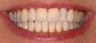 Invisalign, whitening, bonding