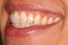 Invisalign