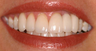 Invisalign, whitening, porcelain veneers and porcelain bridge