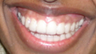Invisalign before and afters