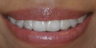 Invisalign before and afters