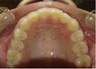 Invisalign Treatment