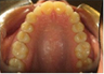Invisalign Treatment