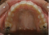 Invisalign Treatment
