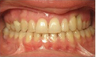 Invisalign Treatment