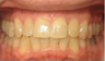Invisalign Treatment