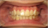 Invisalign Treatment