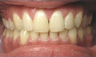 Invisalign Treatment