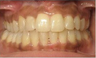 Invisalign Treatment