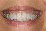 Invisalign and Whitening