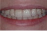 INVISALIGN