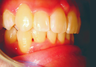 Complex orthodontics with Invisalign