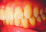 Complex orthodontics with Invisalign