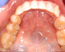 Invisalign