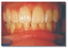 Invisalign for severe crowding/ non extraction