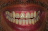 Invisalign