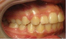 Invisalign Treatment