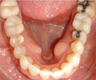 Invisalign used to upright the teeth and broaden the smile.
