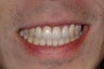 Invisalign Treatment