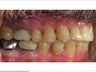Invisalign