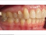 Invisalign