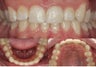 Invisalign braces, whitening and minor gum lift.