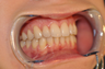 Invisalign for overlapping upper incisors