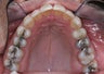 Invisalign