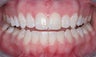 Invisalign