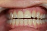 Upper anterior crowns to close gaps & Invisalign