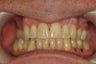 Invisalign