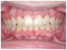 Deep Overbite Correction