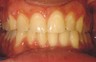 Invisalign for complex cases