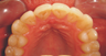 Invisalign 9 years ago