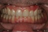 Invisalign Treatment