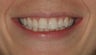 Smile Makeover with Invisalign
