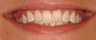 Invisalign and whitening