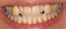Invisalign, whitening, bonding