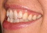 Invisalign