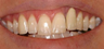 Invisalign, whitening, porcelain veneers and porcelain bridge