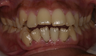 Invisalign before and afters