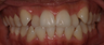 Invisalign before and afters